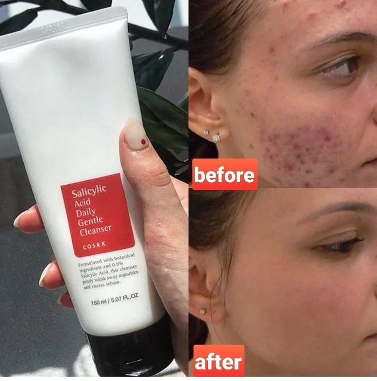ژل شوینده سالیسیلیک اسید کوزارکس