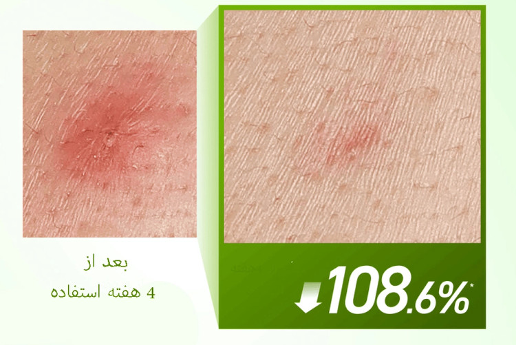 سرم آزلائیک اسید ۱۰٪ آنوا